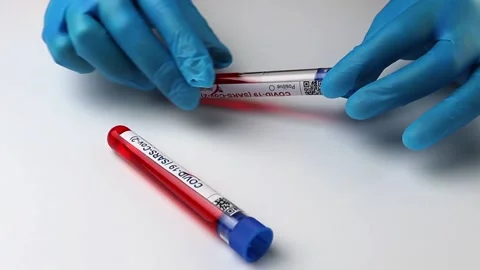 Flasks with blood tests for monkey pox virus positive and negative, mpox Stock Footage 233356606