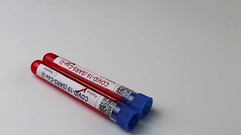 Flasks with blood tests for monkey pox virus positive and negative, mpox Stock Footage 233356609