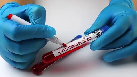 Flasks with blood tests for monkey pox virus positive and negative, mpox Stock Footage 233356615