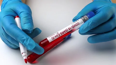 Flasks with blood tests for monkey pox virus positive and negative, mpox Stock Footage 233356639