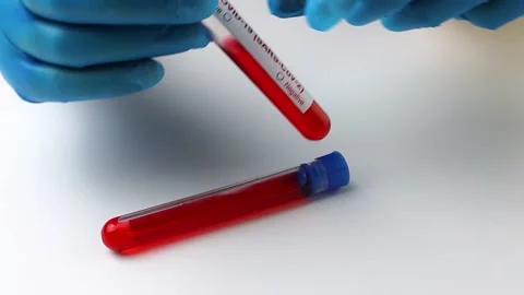 Flasks with blood tests for monkey pox virus positive and negative, mpox Stock Footage 233356653