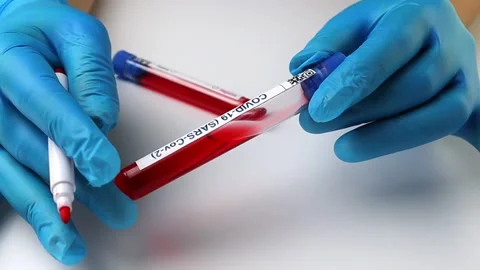 Flasks with blood tests for monkey pox virus positive and negative, mpox Stock Footage 233356654
