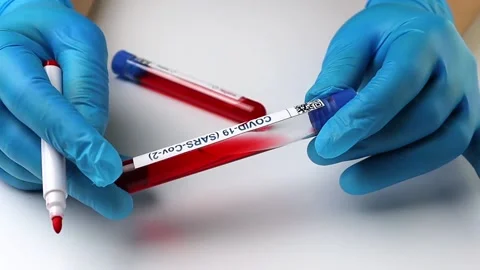 Flasks with blood tests for monkey pox virus positive and negative, mpox Stock Footage 233356655