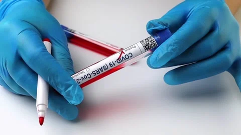 Flasks with blood tests for monkey pox virus positive and negative, mpox Stock Footage 233356669