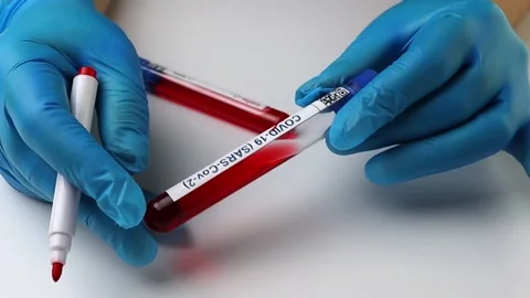 Flasks with blood tests for monkey pox virus positive and negative, mpox Stock Footage 233356674