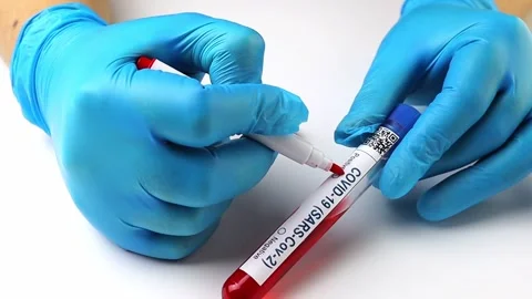 Flasks with blood tests for monkey pox virus positive and negative, mpox Stock Footage 233356675