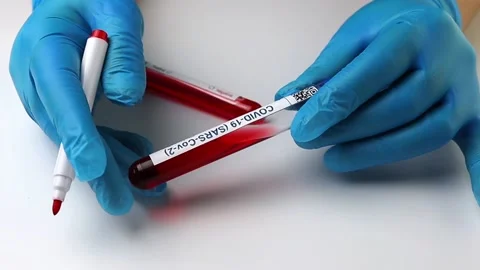 Flasks with blood tests for monkey pox virus positive and negative, mpox Stock Footage 233356680