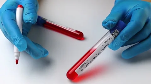 Flasks with blood tests for monkey pox virus positive and negative, mpox Stock Footage 233356681