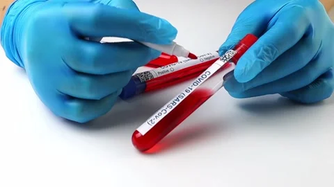 Flasks with blood tests for monkey pox virus positive and negative, mpox Stock Footage 233356690