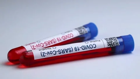 Flasks with blood tests for monkey pox virus positive and negative, mpox Stock Footage 233356697