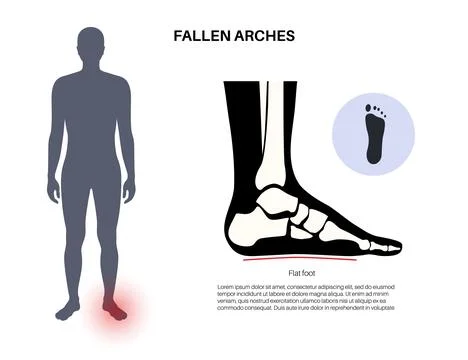 Flat feet anatomy Illustrazione stock
