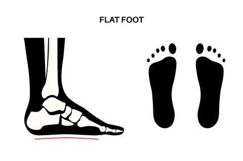 Flat feet anatomy Stock Illustration