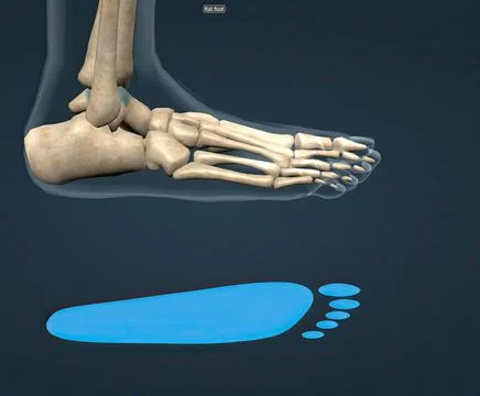 Flat feet is a common condition in which the arches on the inside of the feet Stock Illustration