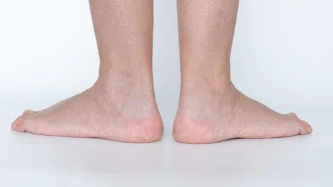 Flat feet condition displayed from the side, showcasing the unique archless Stock Photos