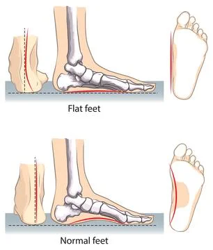 Flat Foot Comparison Stock Illustration