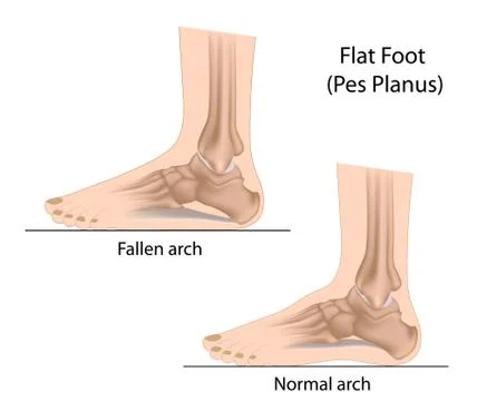 Flat foot Stock-Illustration