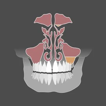 Flat style. Odontogenic sinusitis. Inflammation of the maxillary sinuses due  Stock Illustration