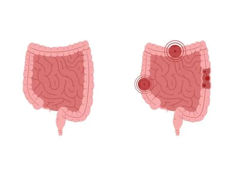  Flat vector illustration of healthy intestines and intestines with inflam... Stock Photos