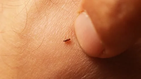 Flea Bite on Veterinarian’s Ankle – Occupational Hazard and Infection Risk Stock Footage 312260742