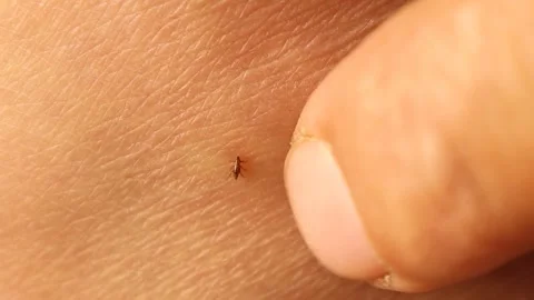 Flea Biting Human Skin Macro, Blood Feeding Parasite Close Up. Zoonotic diseases Stock Footage 325845245