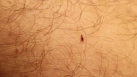Flea Crawling on Human Leg. Parasite Exposure, Skin Risk, Close-Up Insect Shot Stock Footage 312262285