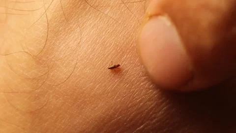 Flea on Human Skin Jumping After Animal to Human Veterinary Exposure Stock Footage 324555870