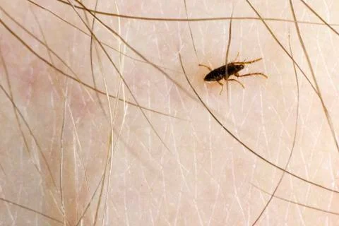 Fleas bite human skin. she is alive. A tiny parasite sucking the blood of peo Stock Photos