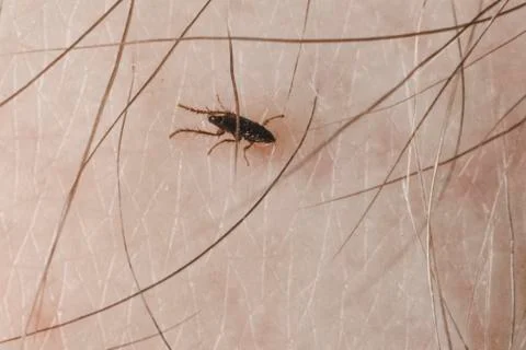 Fleas bite human skin. she is alive. A tiny parasite sucking the blood of peo 스톡 사진