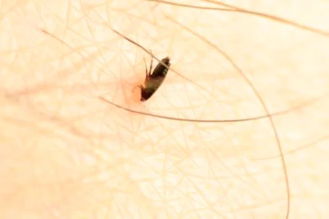 Fleas bite human skin. she is alive. A tiny parasite sucking the blood of peo Foto stock
