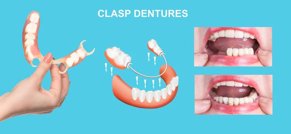 Flexible nylon denture Stock Photos
