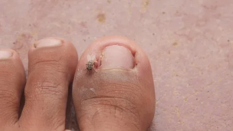 Flies gathered on a man&amp;#039;s big toe due to an ingrown toenail Stock Footage 321978640