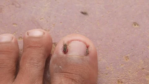 Flies gathered on a man&amp;#039;s big toe due to an ingrown toenail Stock Footage 321978641