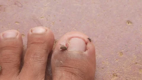 Flies gathered on a man&amp;#039;s big toe due to an ingrown toenail Stock Footage 321978647