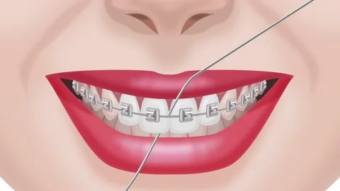 Flossing braces and teeth Stock Footage 151020638