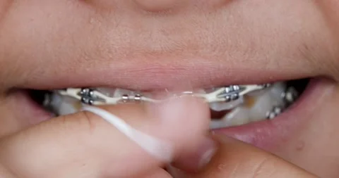 Flossing with braces  Stock Footage 286761456