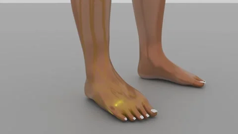 Fluid Triggering Pitting Edema or or Swelling Foot 3D Animation 4K Stock-Footage 330113278