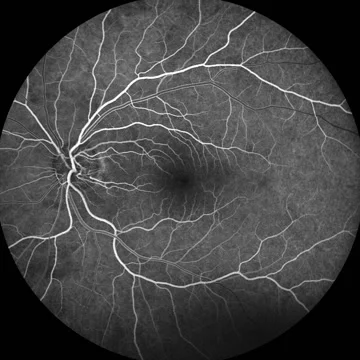 Fluorescein Angiogram Stock-Footage 64801905