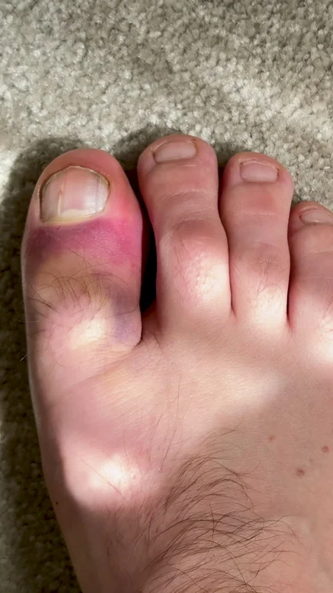 Foot with bruised toe showing progression of visible injury, highlighting 库存影片 340274379
