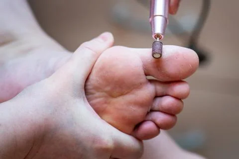 Foot care procedure, featuring an automatic callus remover being used on th.. Stock Photos