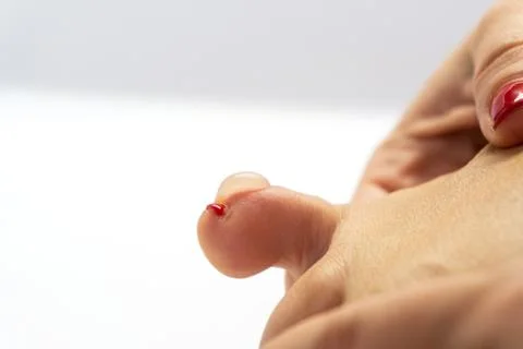 Foot corn, view from a side Stock Photos