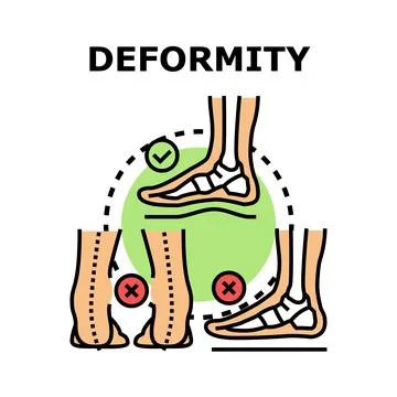 Foot deformation problem with flatfoot and valgus Stock Illustration