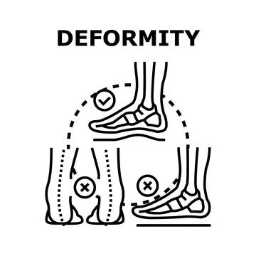 Foot deformation problem with flatfoot and valgus Stock Illustration