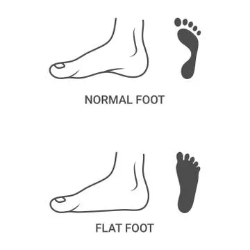 Foot Pathologies, Normal, Flat Foot Isolated On A White Background. Vector Stock Illustration