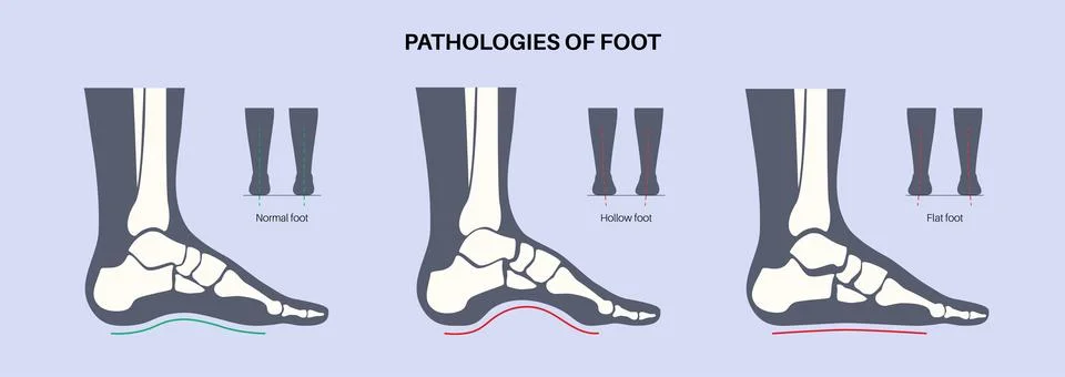 Foot pathologies poster Illustrazione stock