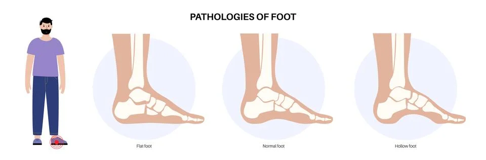 Foot pathologies poster Illustrazione stock