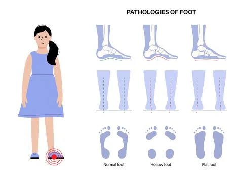 Foot pathologies poster Stock Illustration