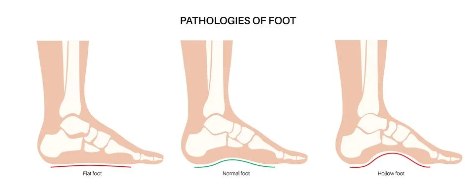 Foot pathologies poster Stock Illustration