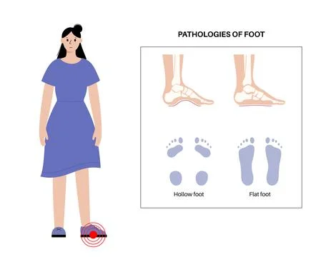 Foot pathologies poster Stock Illustration