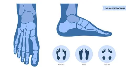 Foot pathologies poster Stock Illustration