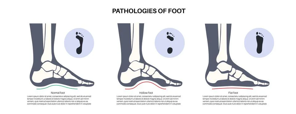 Foot pathologies poster Stock Illustration